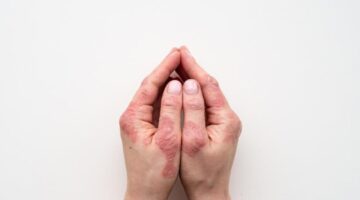 في يومه العالمي.. طبيب يوضح لـ”اليوم” أعراض “الذئبة الحمراء” وأنواعه