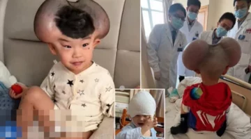 عيب خلقي نادر يغير شكل جمجمة طفل ويتسبب في تنمر بلقب “ميكي ماوس”