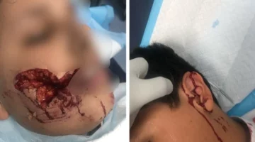 هجوم كلب ضال في تثليث يتسبب بإصابات خطيرة لطفل ونقله لمستشفى عسير
