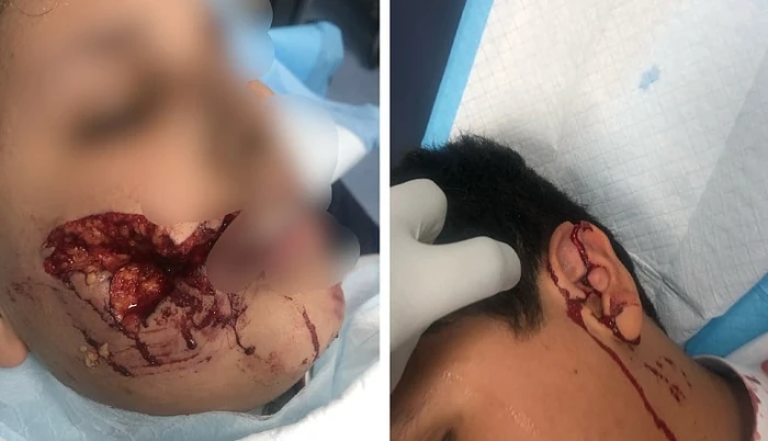 هجوم كلب ضال في تثليث يتسبب بإصابات خطيرة لطفل ونقله لمستشفى عسير